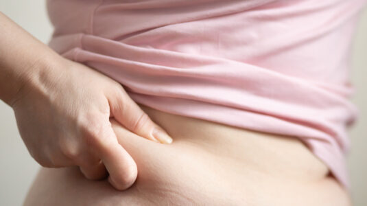 Person kneift sich in die Hüfte, symbolisiert Fettabsaugung