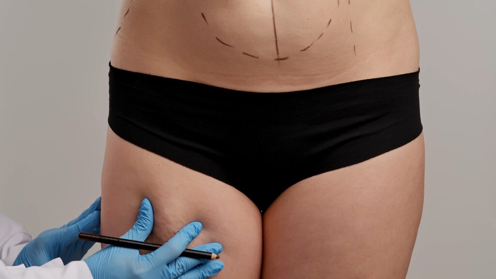 Oberschenkel, Vorbereitung einer Fettabsaugung ohne OP