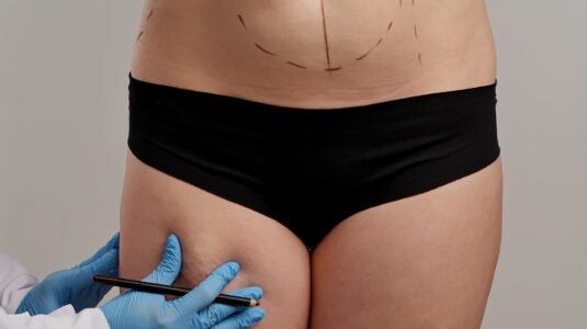 Oberschenkel, Vorbereitung einer Fettabsaugung ohne OP